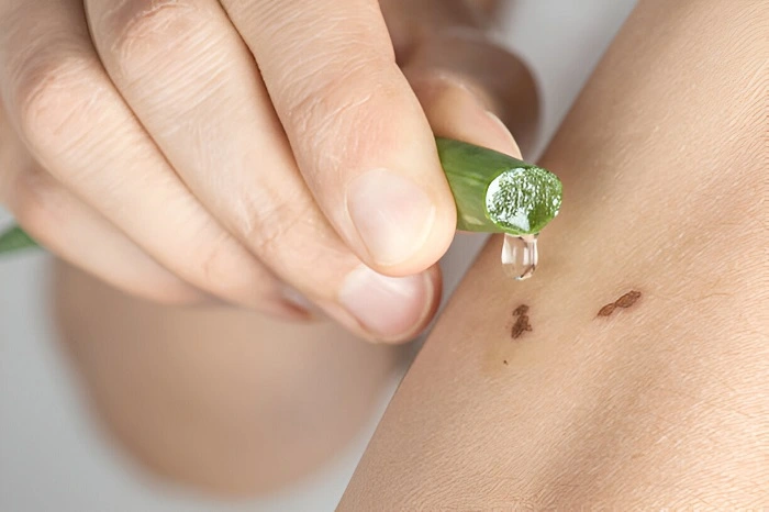 image of applying aloe vera gel on a skin wound
